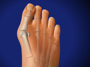 bunion foot surgery