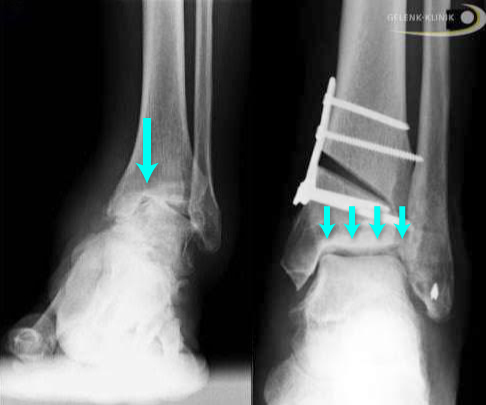 До и после хирургической репозиции большеберцовой кости (остеотомия)