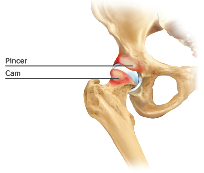 Hip Bone Spurs, Symptoms and Treatment