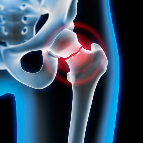 El fémur está conectado a la articulación de la cadera a través del cuello femoral. La osteoporosis reduce la densidad ósea y aumenta la probabilidad de fracturas cuando las personas se caen.