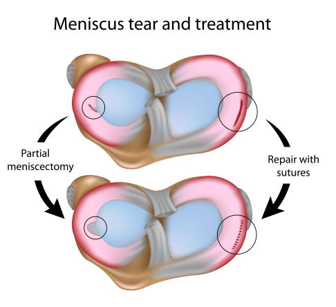 Is it good to walk with a torn inner meniscus? - Natural Wellbeing