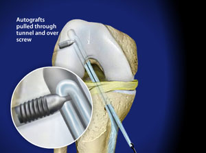 ACL Injury  ACL Reconstruction - Spine & Orthopedic Center