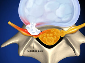 Degenerated Spinal Disc 