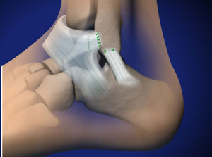 Ankle Ligament Reconstruction Treating Chronic Ankle Instability Joint Surgeon Com