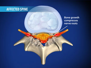 Spinal Stenosis Surgery & Treatments