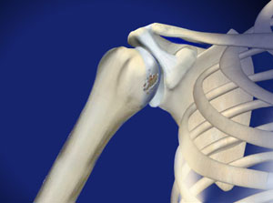 Shoulder specialist approach to shoulder arthritis